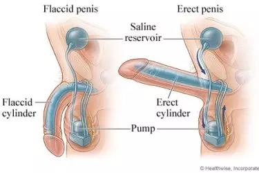 best doctor for penile implant surgery in india, best doctor for 3 piece penile implant in india, ams 700 lgx penile implant cost in india, best hospital for penile implent surgery in india, best results in penile implant surgery in india, infection free penile implant surgery in india