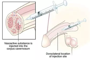 Penile Injections for Treatment of ED, How To Use Penile Injections, Safety of Penile Injections for Erection