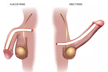 best doctor for penile implant surgery in india, best doctor for malleable penile implant in india, semi rigid penile implant cost in india, best hospital for penile implent surgery in india, best results in penile implant surgery in india, infection free penile implant surgery in india